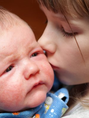 Baby’s face with eczema